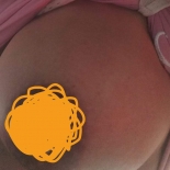 Áp xe ngực sau sinh là gì?