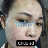 3 quá trình của chị khách đã trải qua khi điều trị mụn trứng cá bằng thảo dược an an